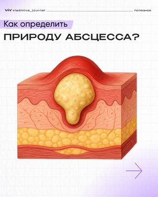 Абсцесс в полости рта: диагностика и лечение гнойника.